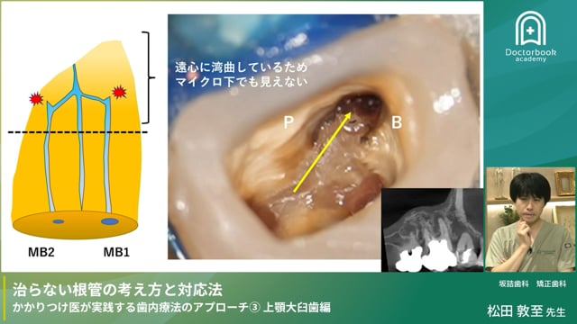 「治らない根管」 の考え方と対応法③ 〜かかりつけ医が実践する歯内療法のアプローチ〜 上顎大臼歯編