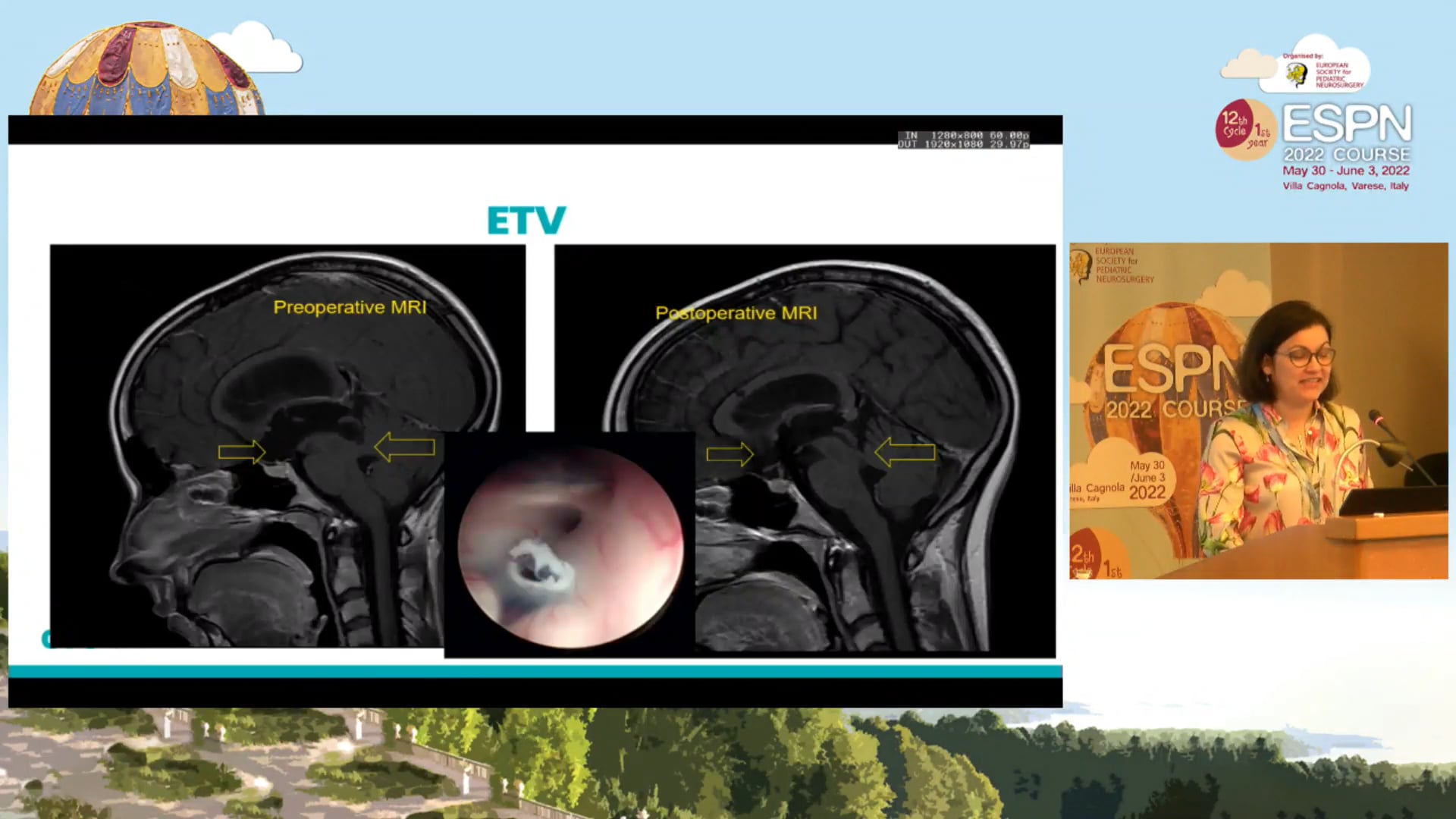 Complications of ETV