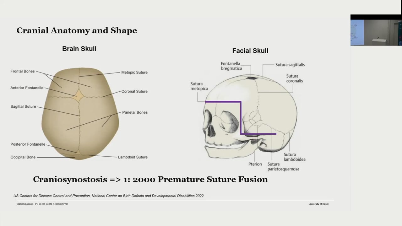 Quantifying Cranial and Facial Shape Changes Using 3D Photogrammetryin Syndromic and Non – Syndromic Craniosynostosis