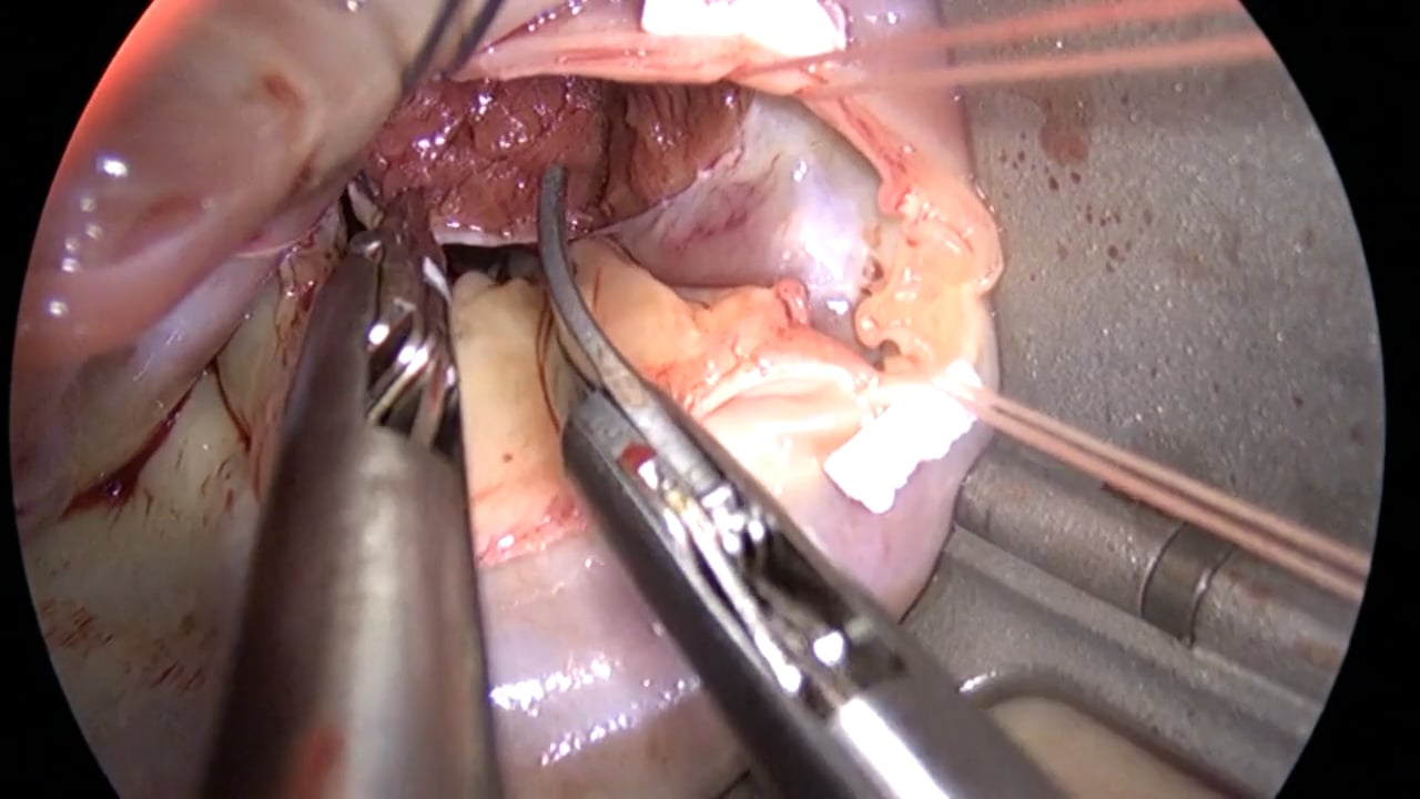 Endoscopic treatment of hypertrophic obstructive cardiomyopathy ...