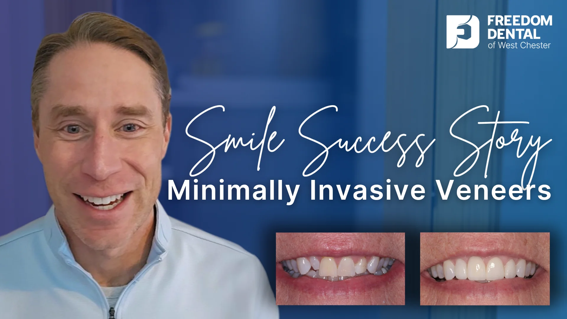 Patient Smile Gallery | Freedom Dental of West Chester