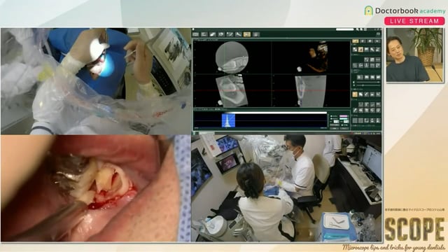 下顎埋伏智歯のMinimal Extraction、どうするの？
