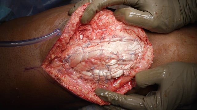 Quadriceps Umbrella with Achilles and Durable Suture (QUADS) Technique for Chronic Quadriceps Tendon Reconstruction