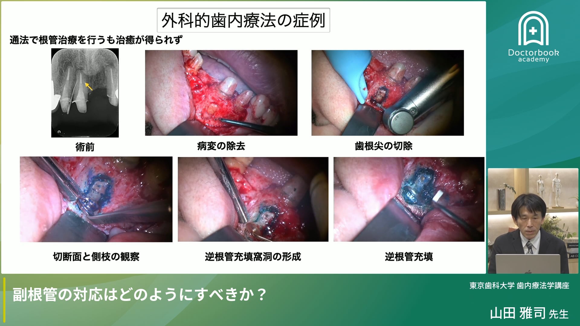 歯の発生と根管形態の関連性および副根管治療の戦略