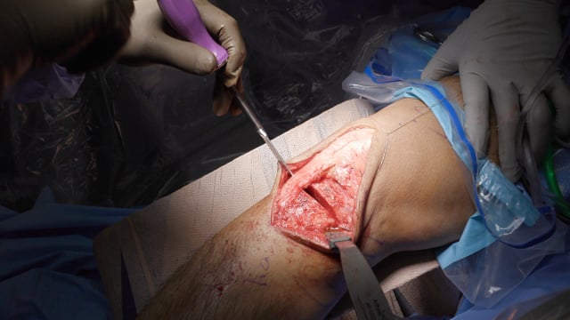 Revision ACL Reconstruction with Anterior Closing Wedge Osteotomy using Patient Specific Instrumentation
