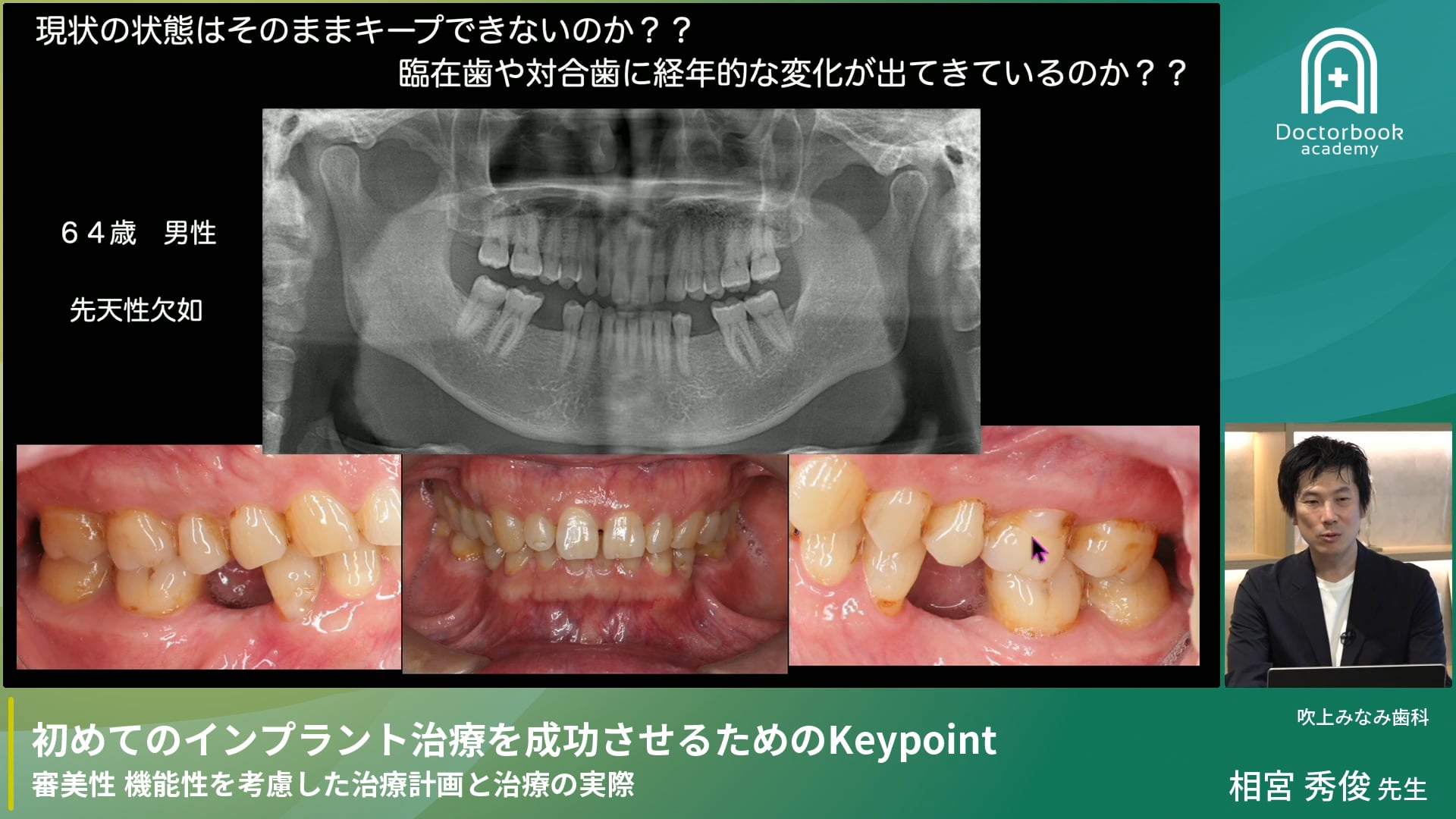 初めてのインプラント治療を成功させるためのKeypoint 審美性 機能性を考慮した治療計画と治療の実際