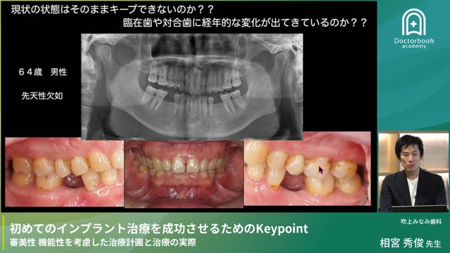 初めてのインプラント治療を成功させるためのKeypoint 審美性 機能性を考慮した治療計画と治療の実際