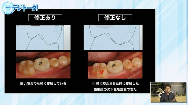 咬合調整の少ない補綴物を製作するためにはどうスキャンしたらいいの？