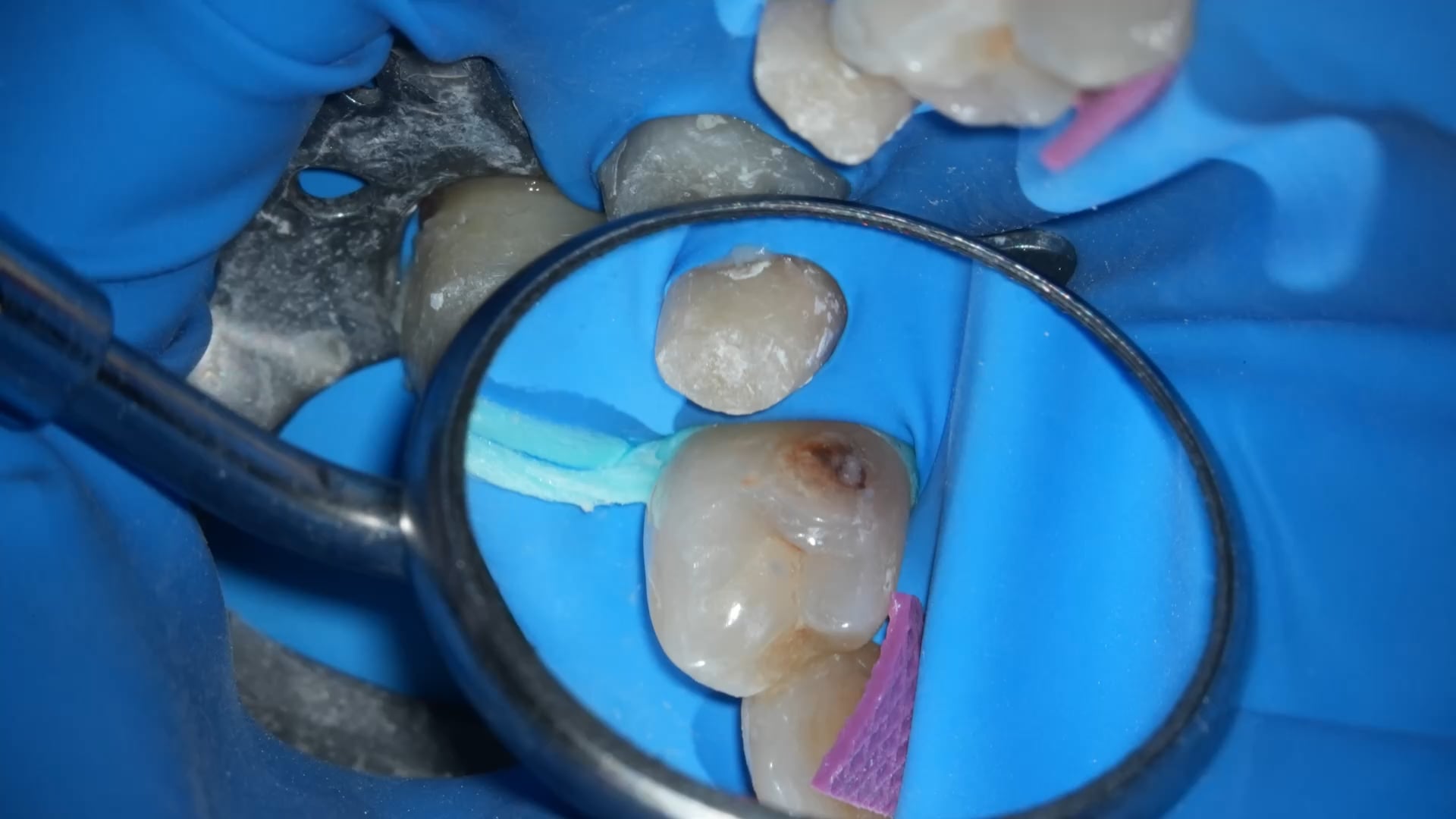 【GPB_direct-bonding_llp_010】術前