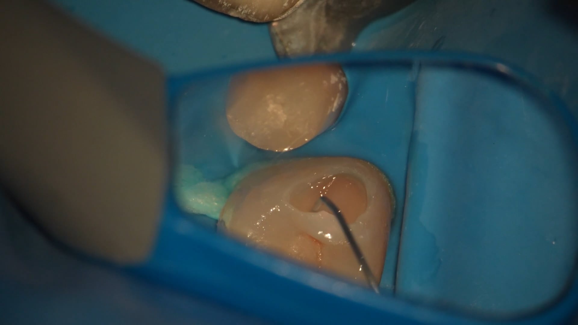 【GPB_direct-bonding_llp_040】充填