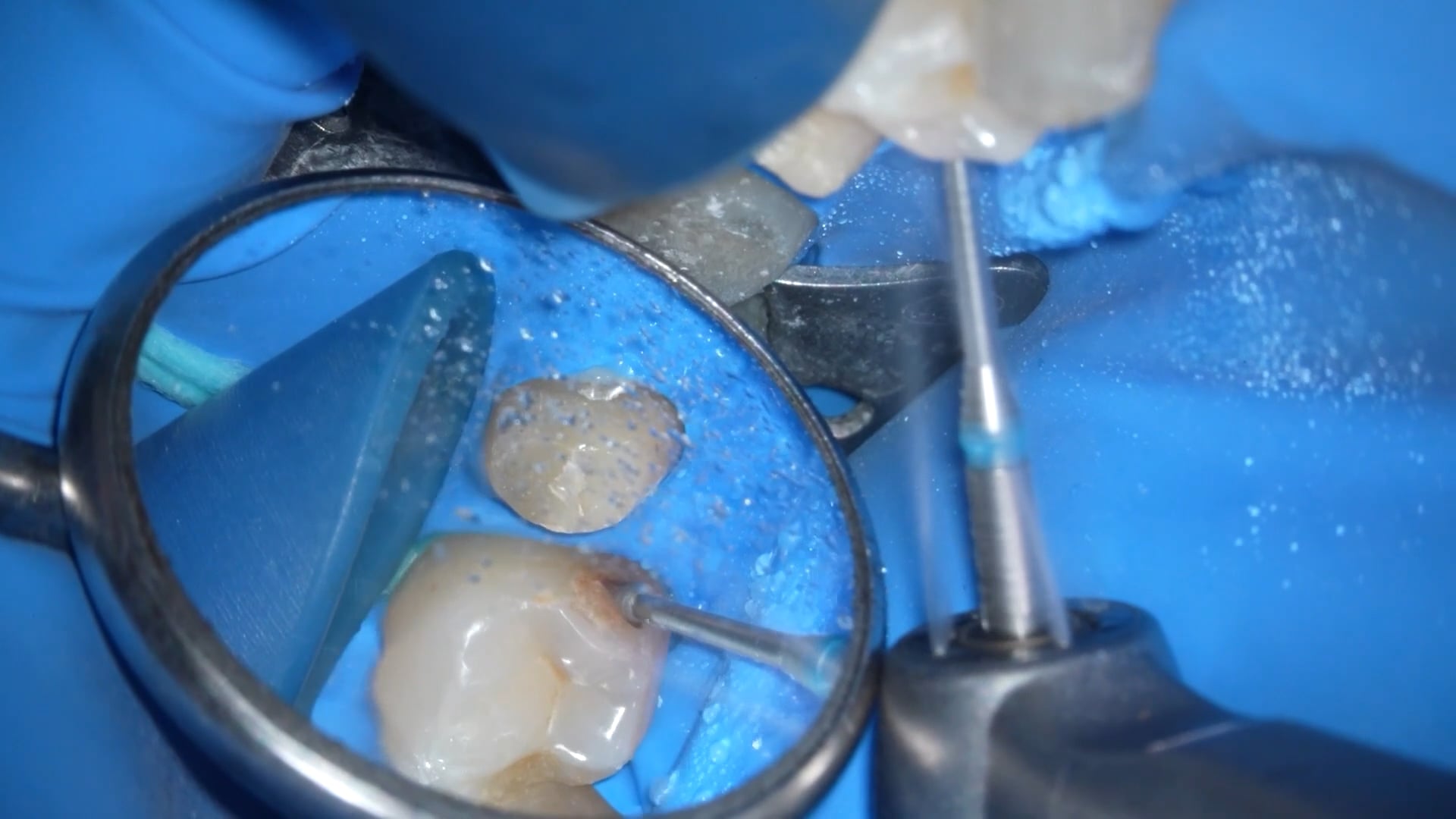 【GPB_direct-bonding_llp_020】う蝕除去