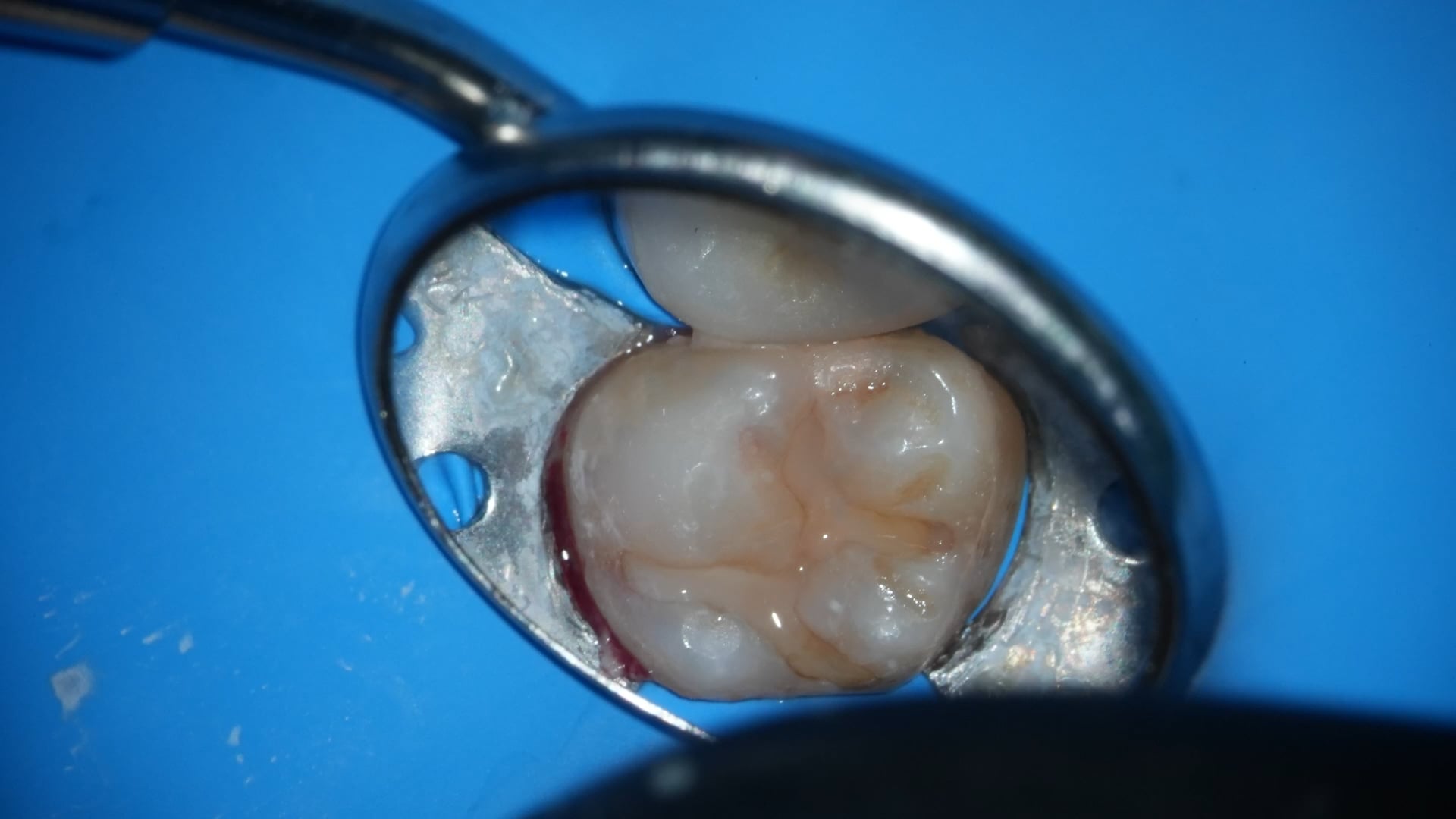 【GPB_direct-bonding_rup_010】術前