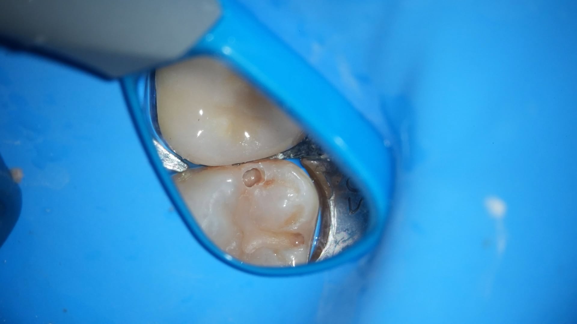 【GPB_direct-bonding_rup_020】う蝕除去