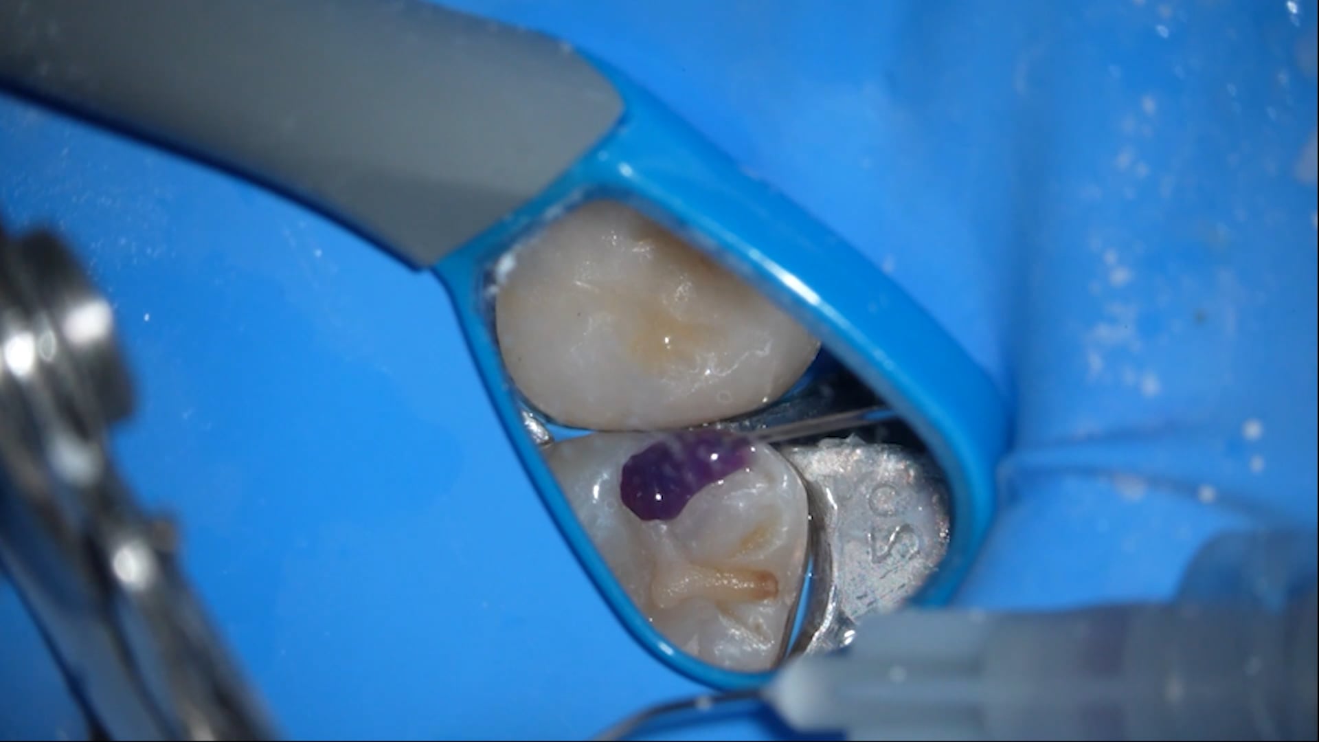 【GPB_direct-bonding_rup_030】前処理