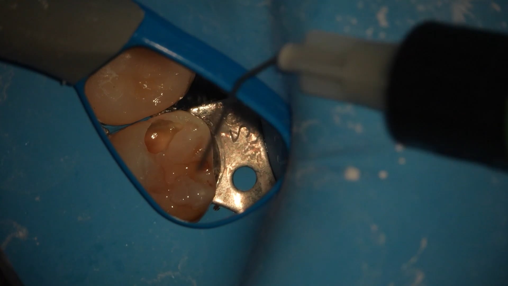 【GPB_direct-bonding_rup_040】充填