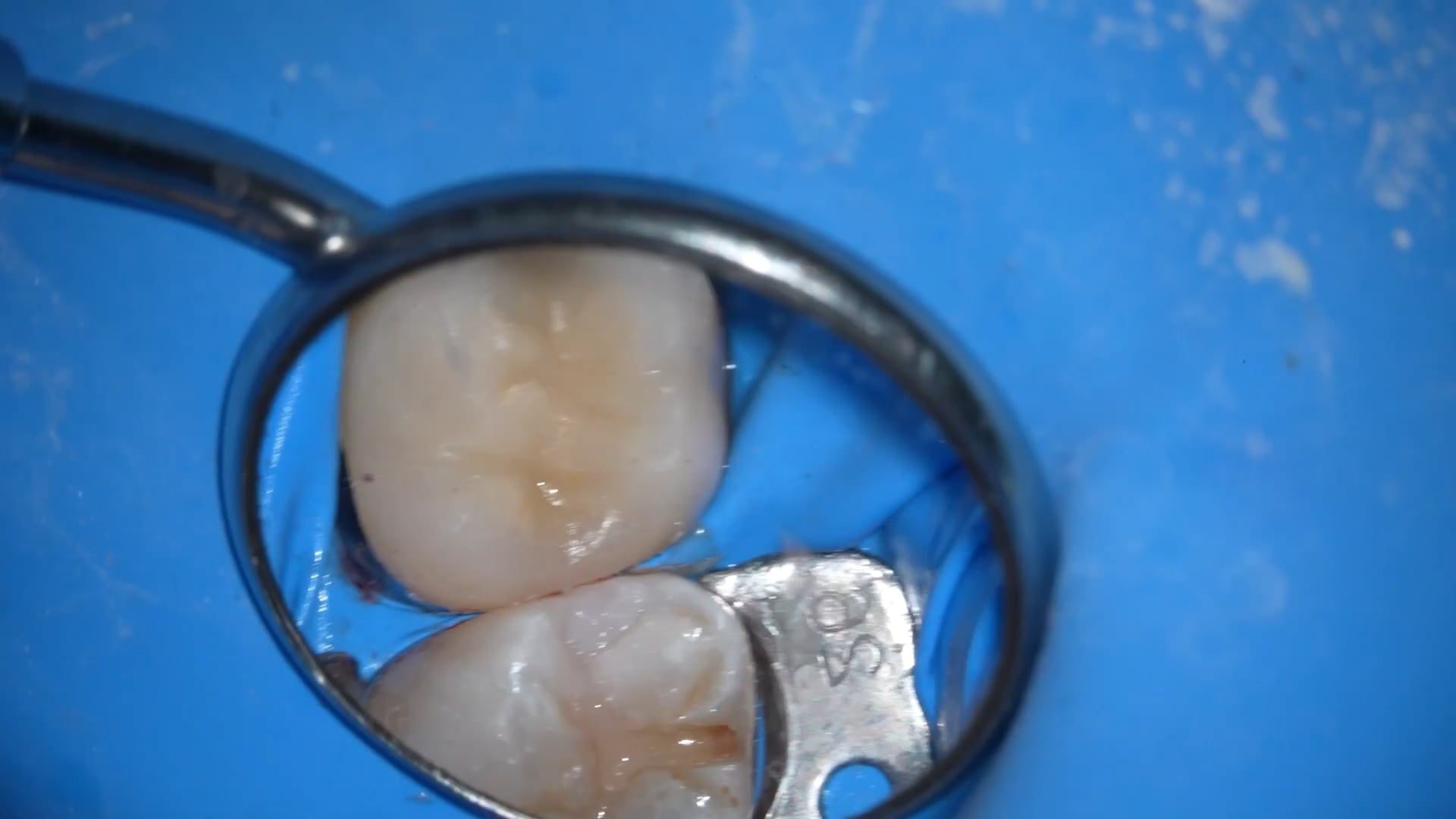 【GPB_direct-bonding_rup_060】術後