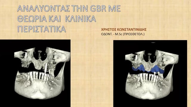Αναλύοντας την GBR με θεωρητικά και κλινικά περιστατικά.
