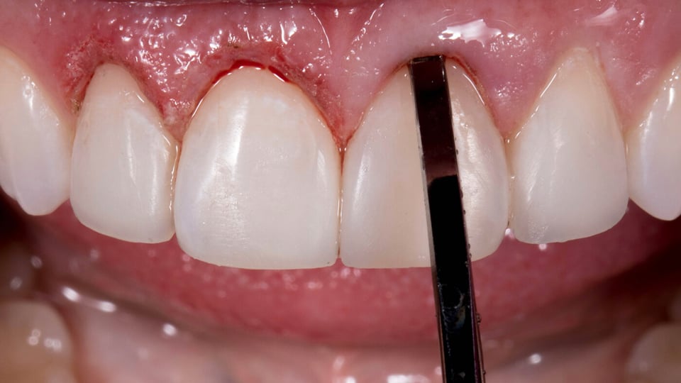 Guide to Minimally Invasive Smile Transformations