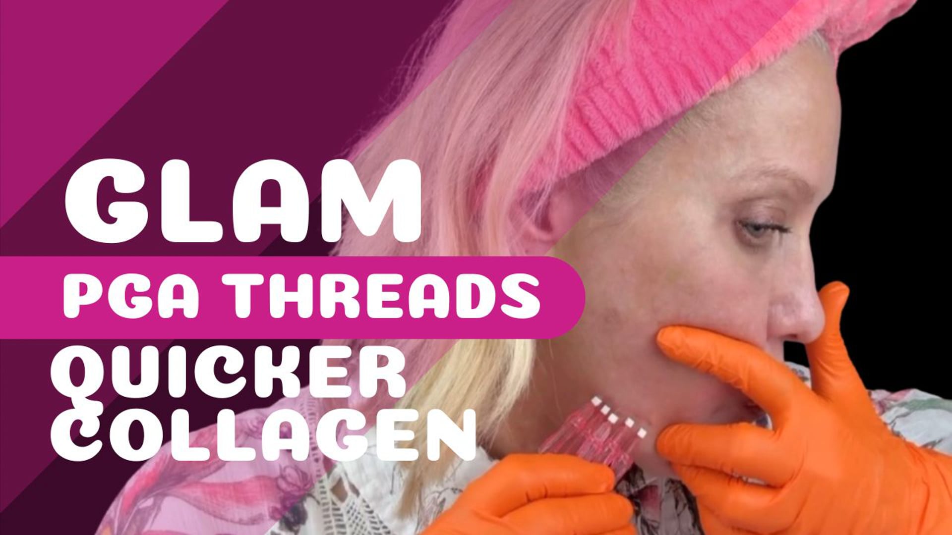 Glam PGA Threads - Nasalabial Folds, Lip Lines, Jawline Tightening