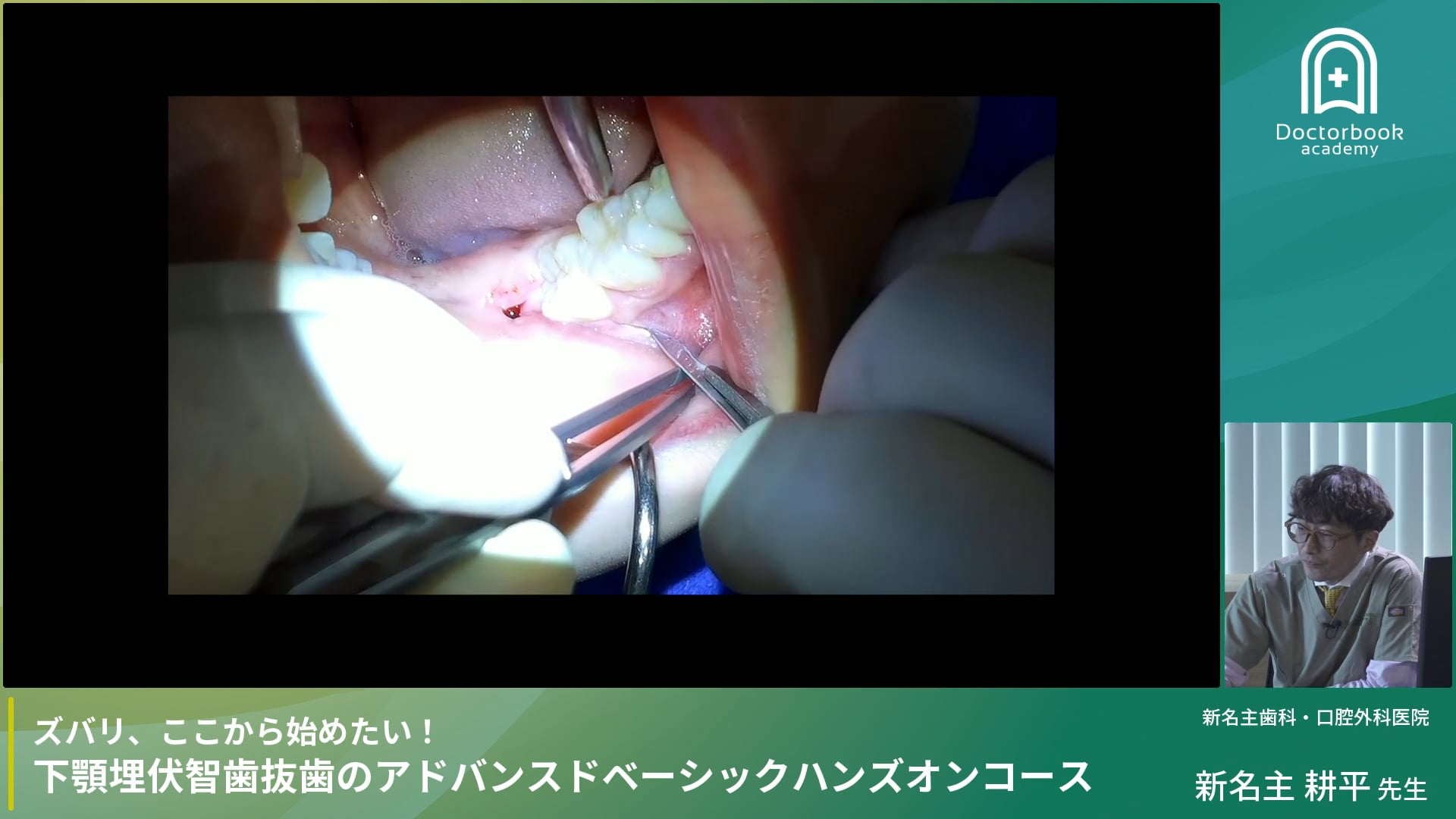 下顎埋伏智歯抜歯：切開・剥離・縫合 #3