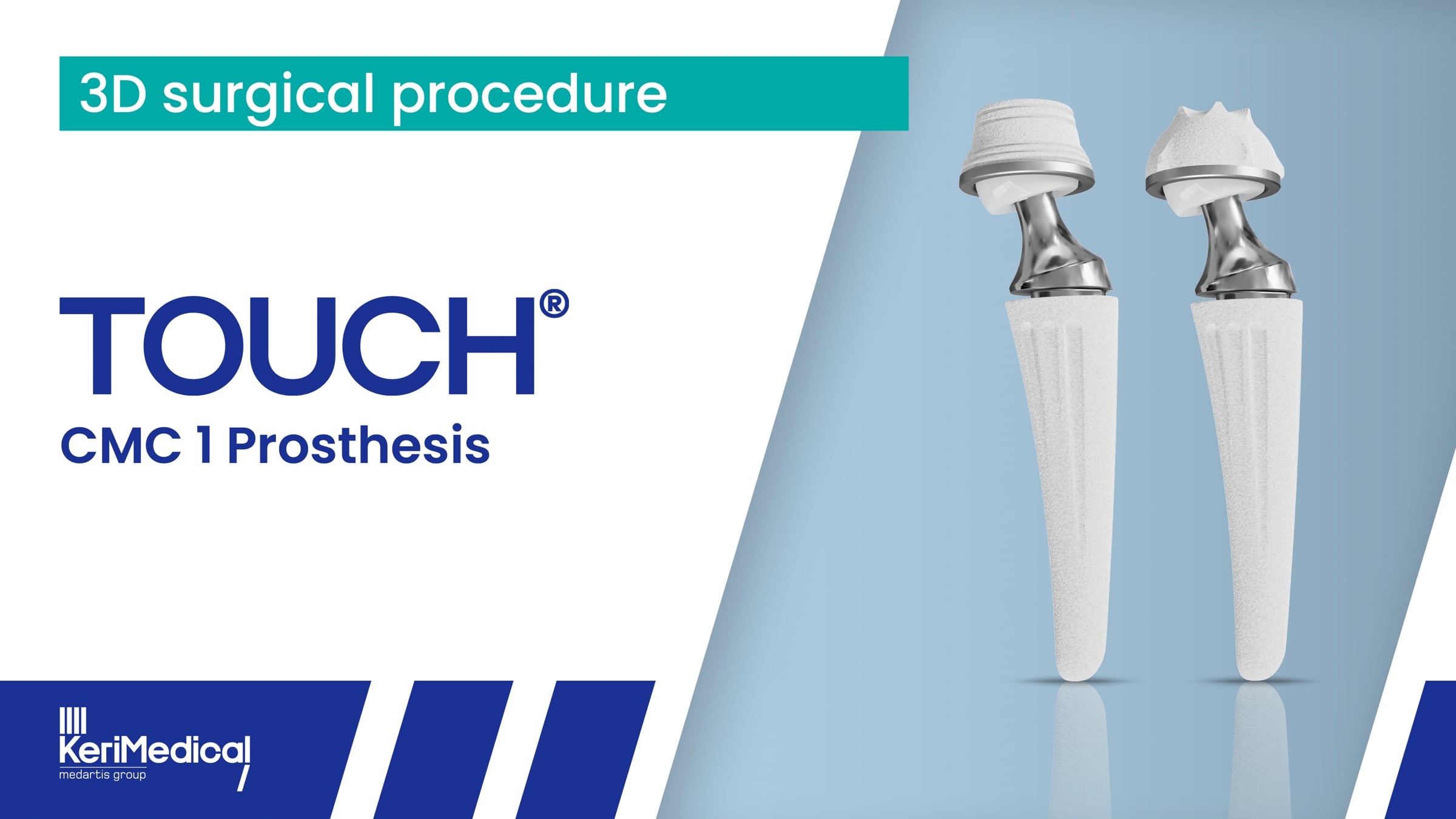 Surgical Procedure - TOUCH® - Dual Mobility CMC1 Prosthesis