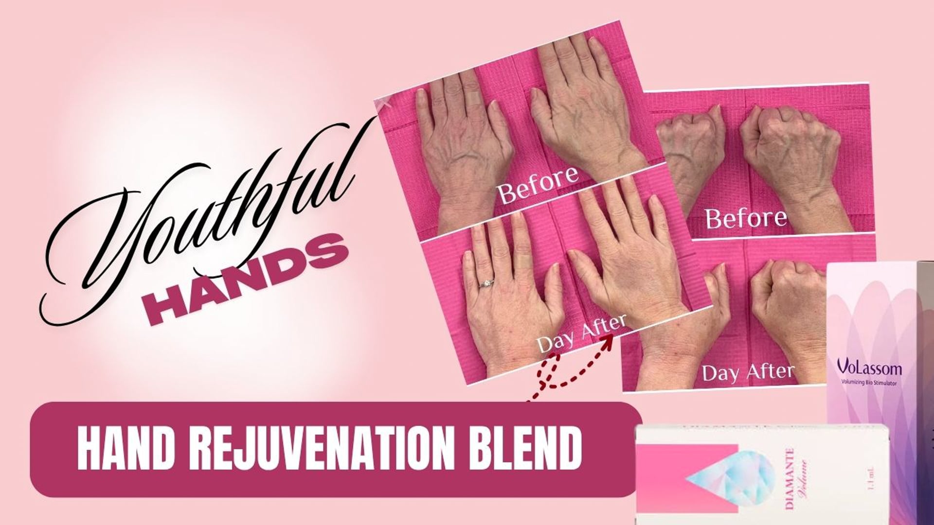 Youthful Hands with Volassom + Diamante Blend