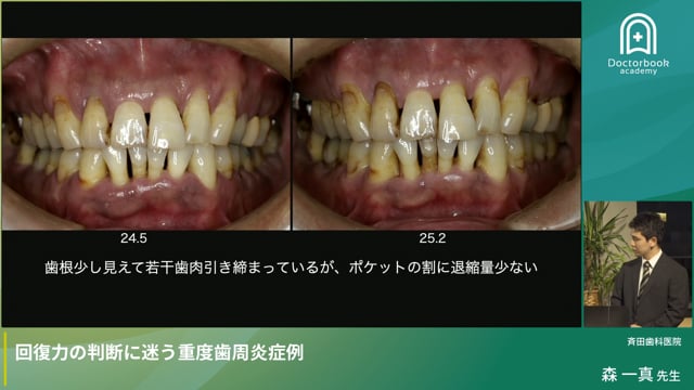 回復力の判断に迷う重度歯周炎症例（森一真先生）