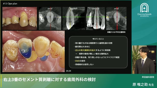 右上3番のセメント質剥離に対する歯周外科の検討（原唯之助先生）