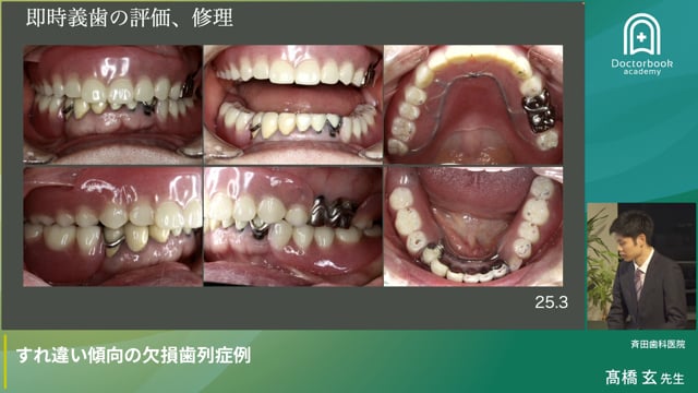 すれ違い傾向の欠損症例（髙橋玄先生）