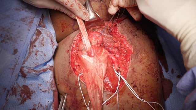 Hamstring Augmentation and Muscle Matrix Enhanced Reconstruction (HAMMER) Technique for Chronic Proximal Hamstring Rupture