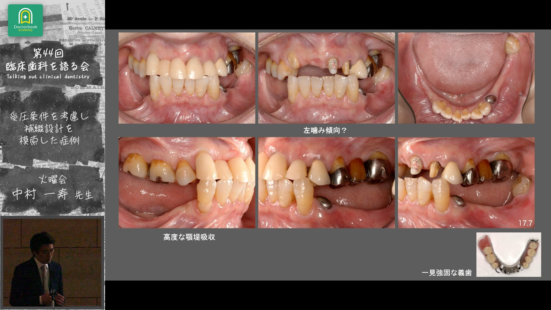 受圧条件を考慮し補綴設計を模索した症例：中村一寿先生｜会員発表