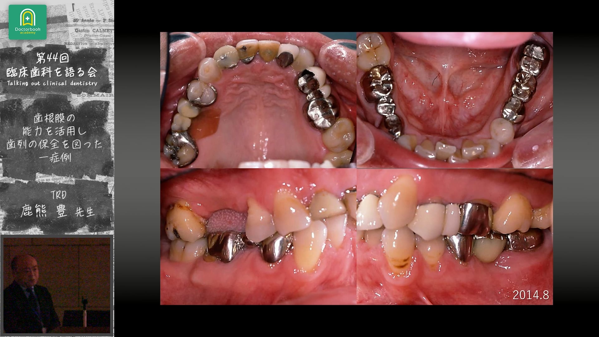 歯根膜の能力を活用して歯列の保全を図った一症例：鹿熊豊先生｜会員発表