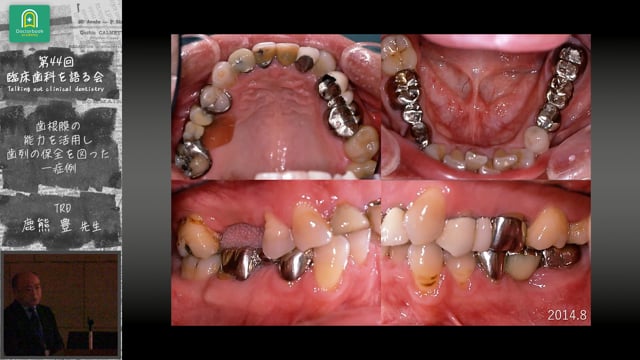 歯根膜の能力を活用して歯列の保全を図った一症例：鹿熊豊先生｜会員発表