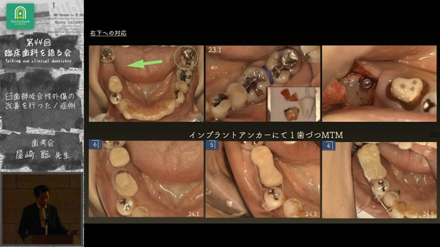 再評価の重要性を再認識した重度慢性歯周炎症例：尾崎 聡先生｜会員発表