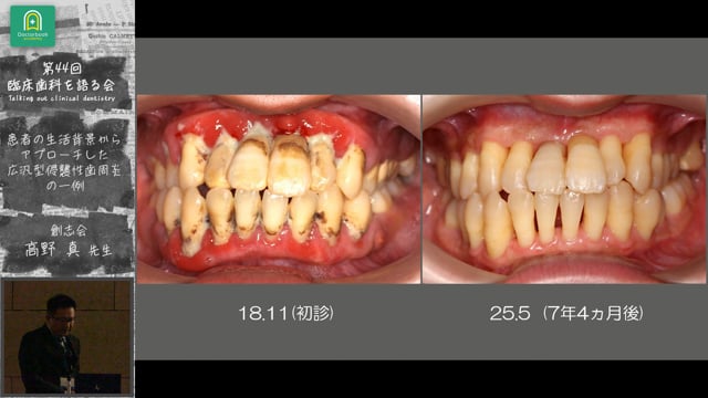 患者の生活背景からアプローチした広汎型浸襲性歯周炎の一例：高野 真先生｜会員発表