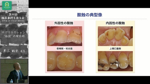 アブフラクション"仮説" の現在地：黒江 敏史先生｜全体会