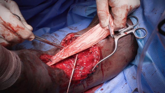 Chronic Distal Biceps Tendon Rupture Reconstruction with Achilles Tendon Allograft: REBAAR Technique