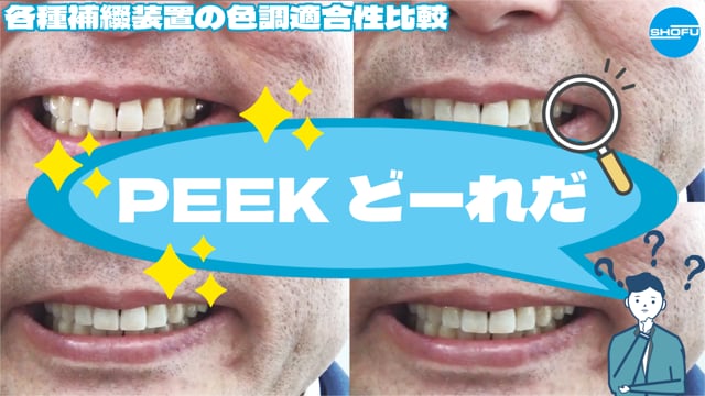 PEEKど〜れだ？-各種補綴装置の色調適合性比較-
