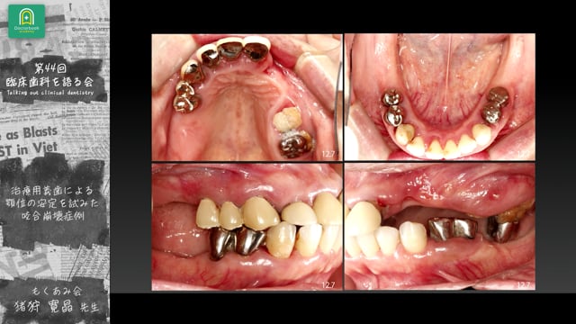 治療用義歯による顎位の安定を試みた咬合崩壊症例：猪狩 寛晶先生｜分科会「咬合崩壊症例の治療ステップ ~治療用義歯をどう活用するか~」