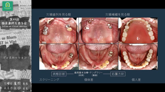 ディスカッション｜分科会「咬合崩壊症例の治療ステップ ~治療用義歯をどう活用するか~」