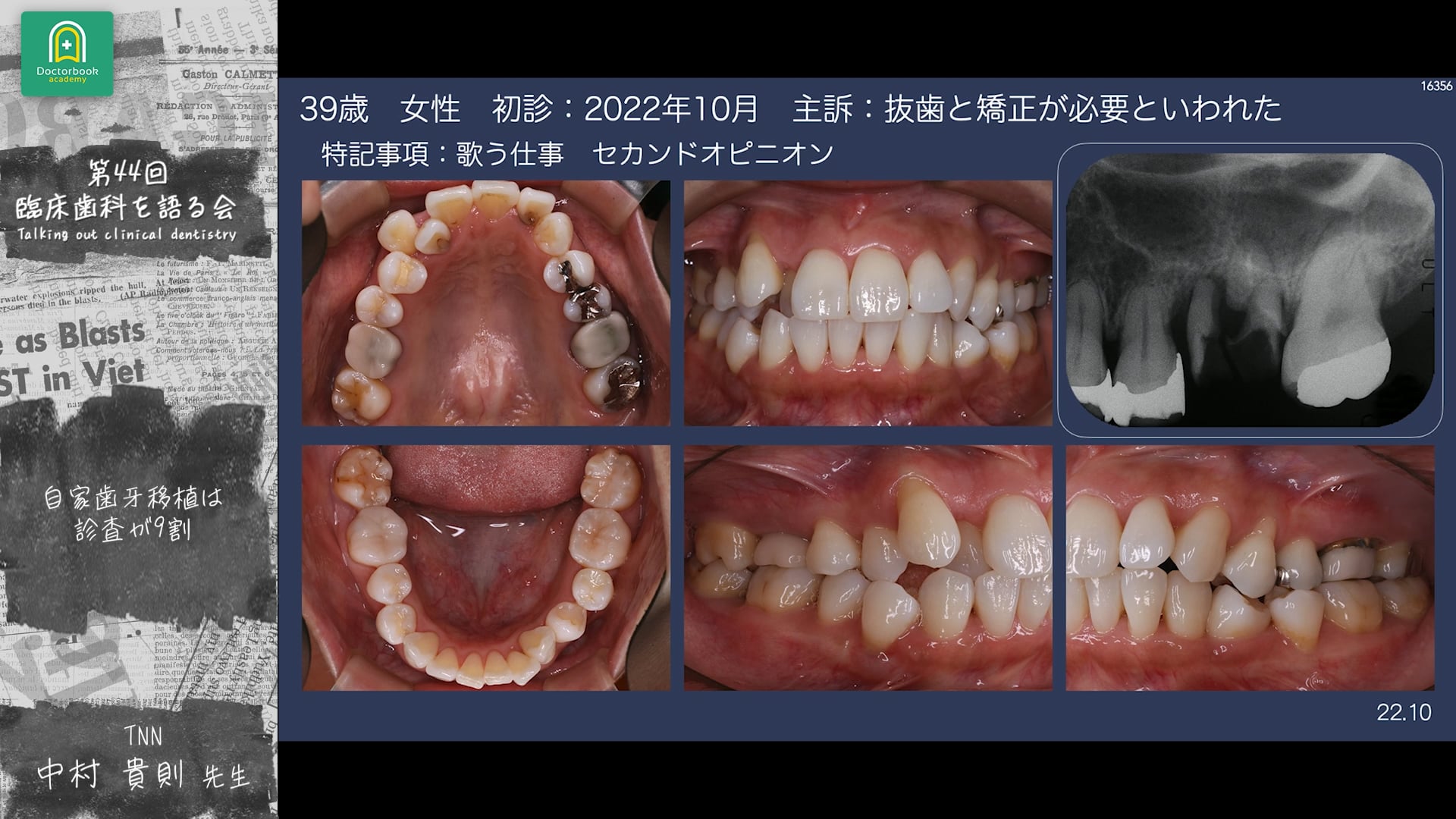 自家歯牙移植は「診査」が9割：中村 貴則先生｜分科会 「今あらためて 自家歯牙移植を考える」