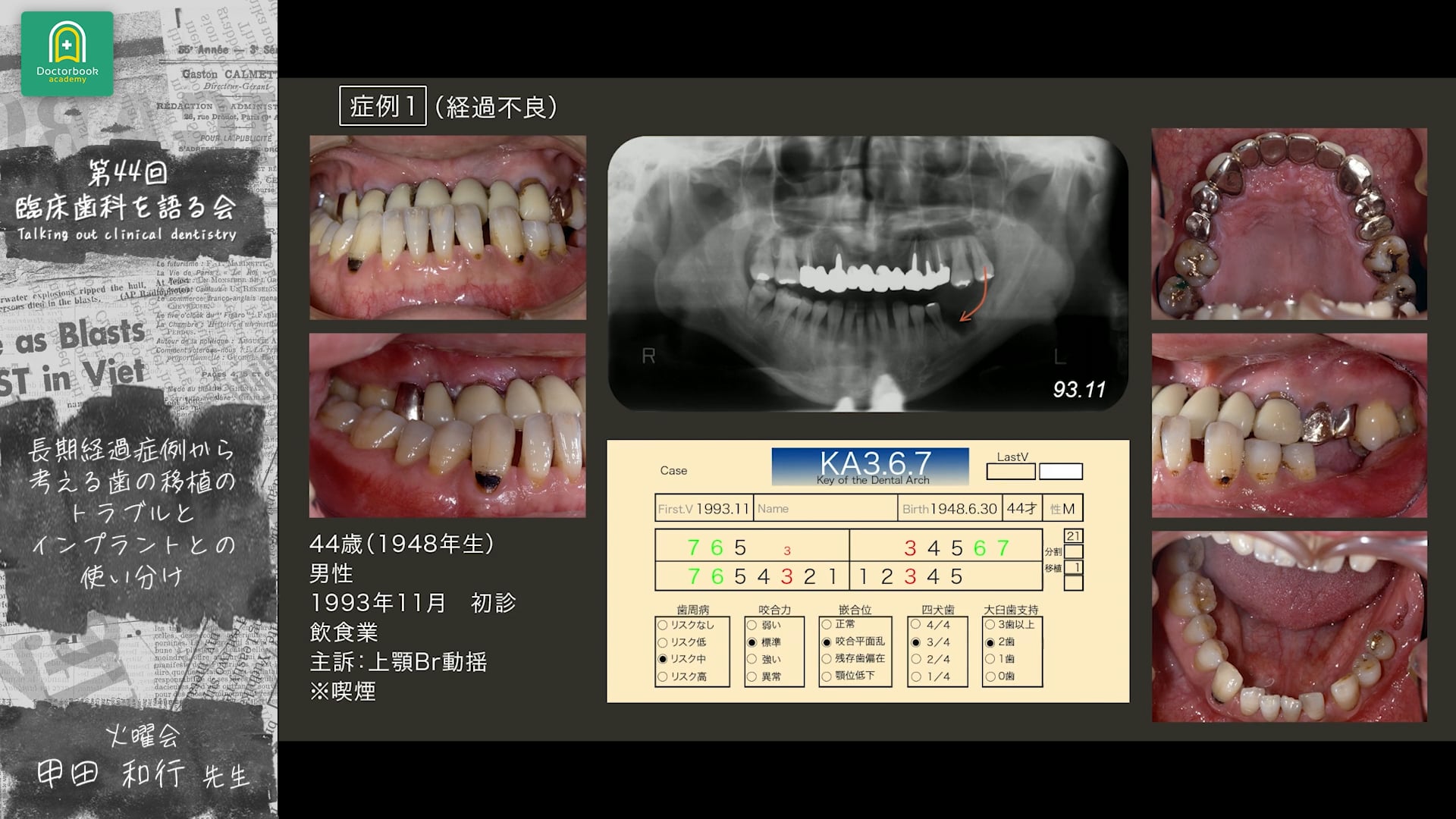 長期経過症例から考える「歯の自家移植におけるトラブルとインプラントとの使い分け」：甲田 和行先生｜分科会 「今あらためて 自家歯牙移植を考える」