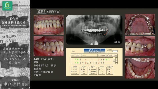 長期経過症例から考える「歯の自家移植におけるトラブルとインプラントとの使い分け」：甲田 和行先生｜分科会 「今あらためて 自家歯牙移植を考える」