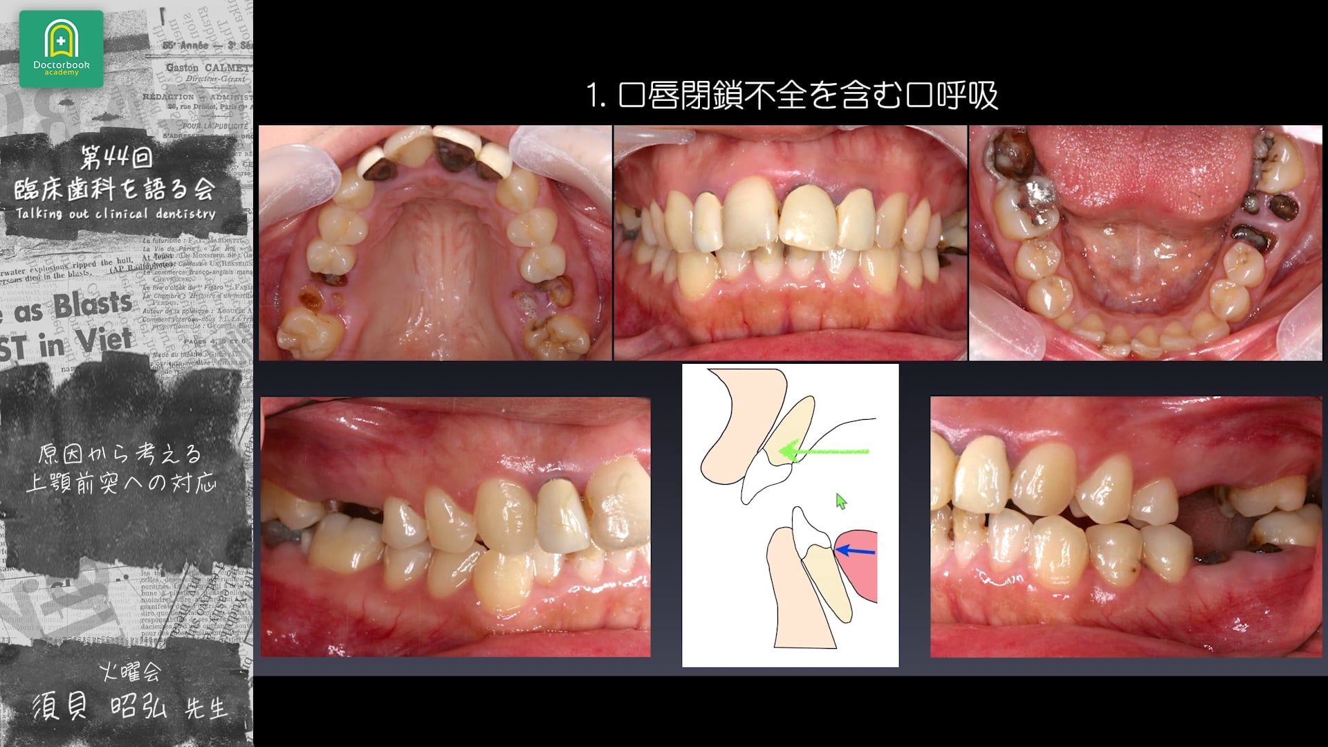 原因から考える上顎前突への対応：須貝 昭弘先生｜分科会 「成長期の上顎前突に対する早期矯正治療 」