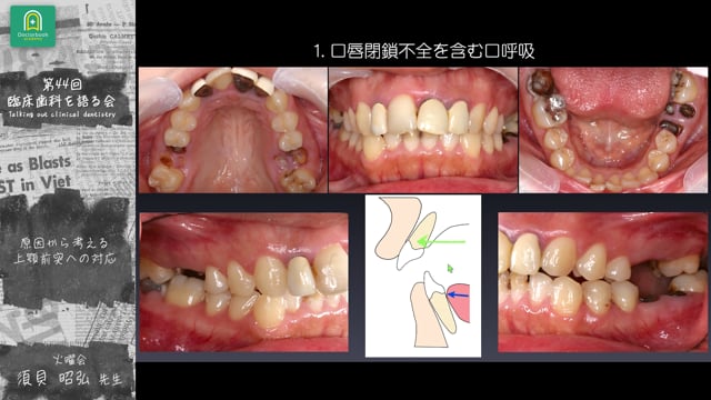 原因から考える上顎前突への対応：須貝 昭弘先生｜分科会 「成長期の上顎前突に対する早期矯正治療 」