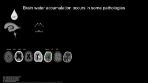 Inhibition of TRPV4 as a pharmacological treatment of posthemorrhagic hydrocephalus-Trine L.Toft-Bertelsen
