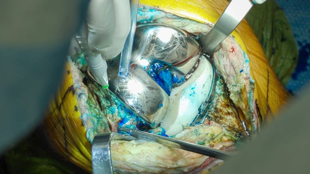 One-Stage Revision Total Knee Arthroplasty using Methylene Blue-Guided Debridement