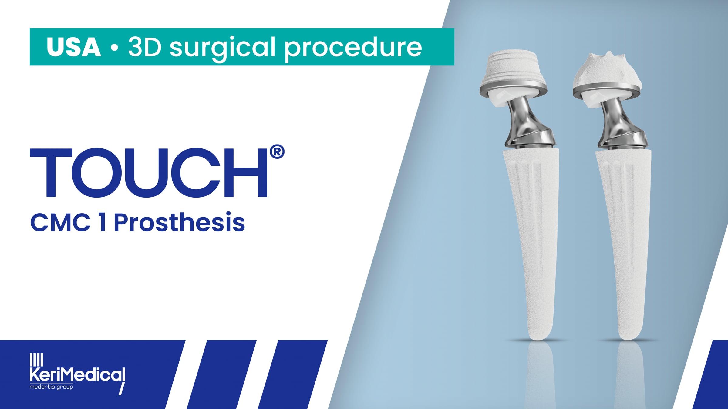 US Surgical Procedure - TOUCH® - CMC 1 Prosthesis