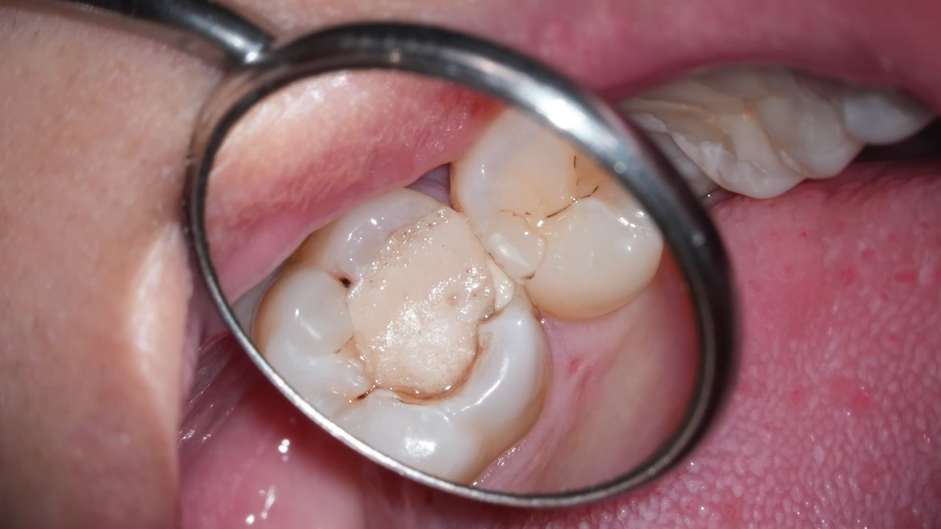 【GPB_direct-bonding_lup_010】術前