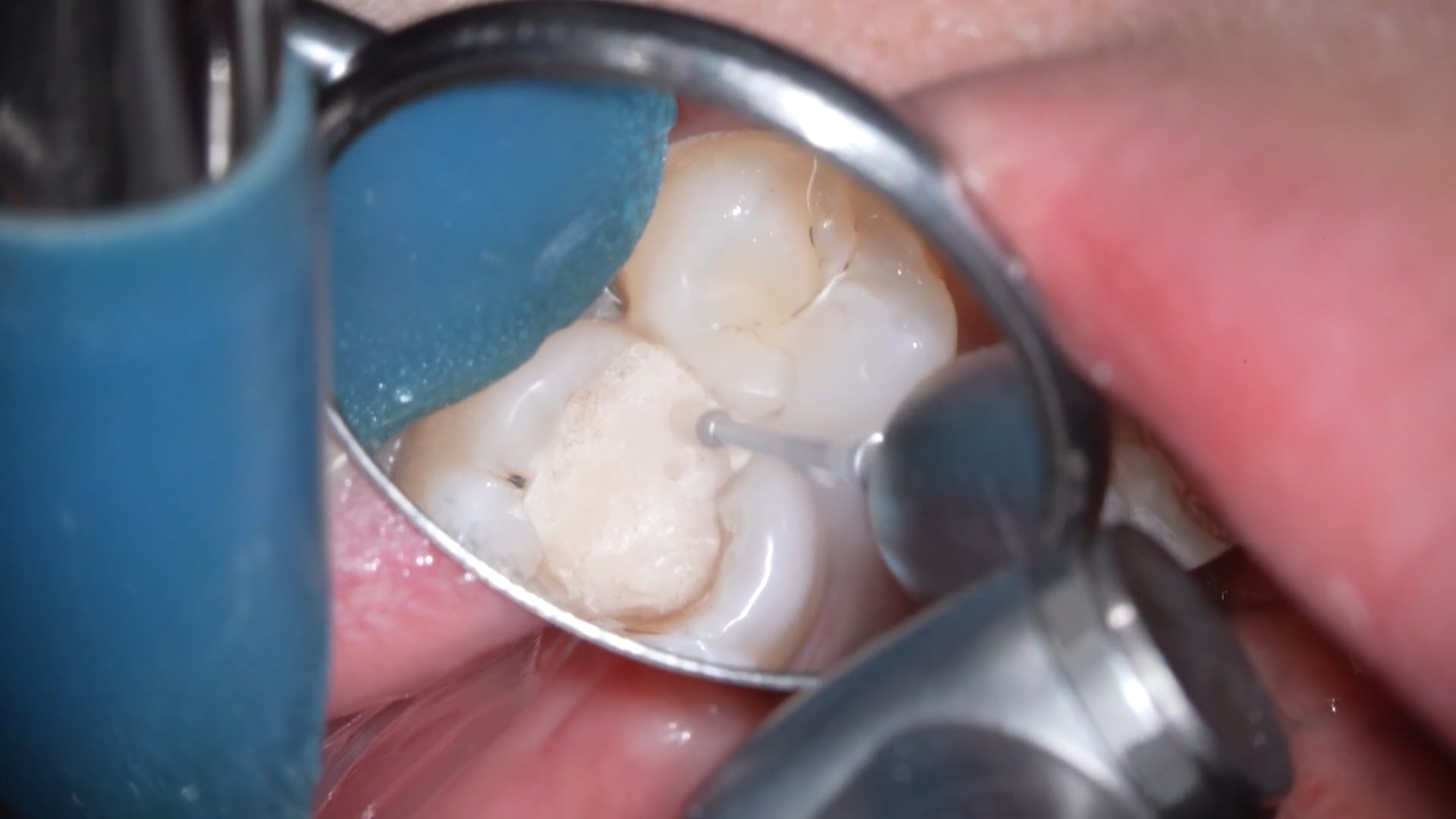 【GPB_direct-bonding_lup_020】う蝕除去